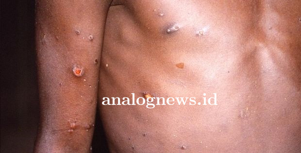 monkeypox-2_169.jpg